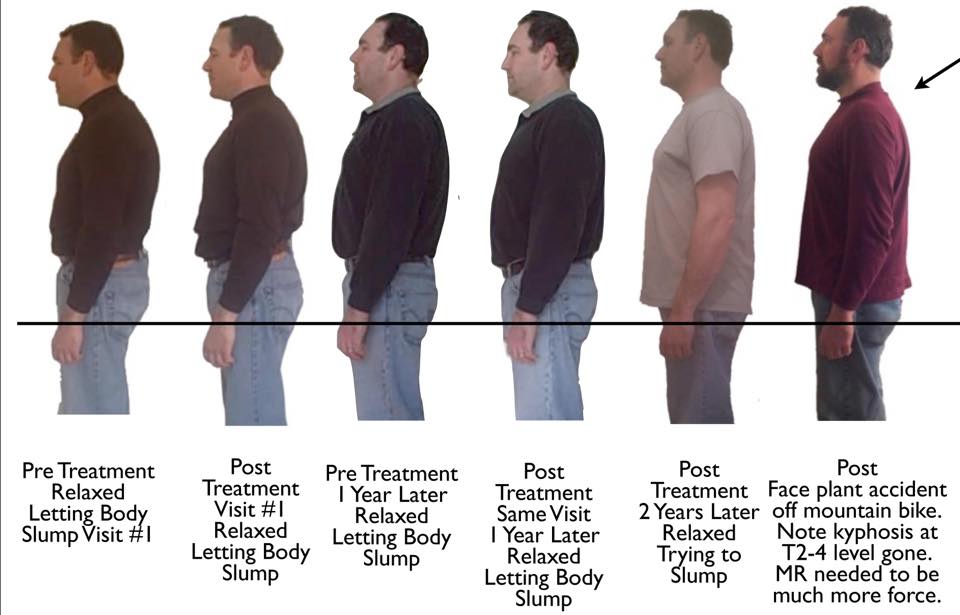 Photos showing posture improvement over 2 years of ABC™ care