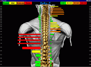 Graphic showing results from a Spinal Thermography scan