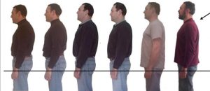 Image showing improvements in posture over a period of 2 years when undergoing ABC treatment