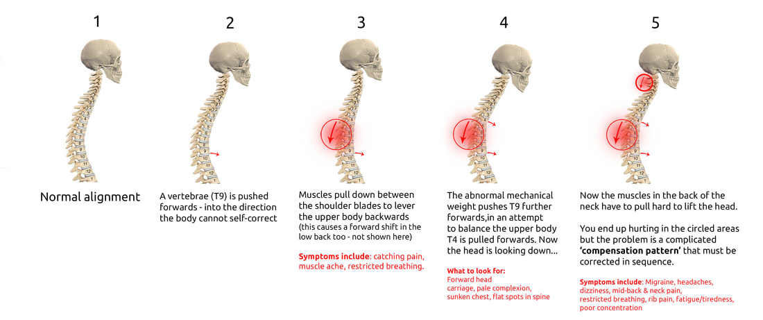 Graphic showing a sequence of events starting from a forward vertebra and leading to collapsed posture