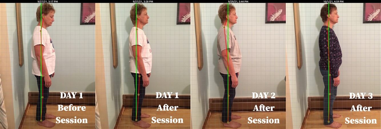 Photo showing improvements in posture of a female client over 3 treatments