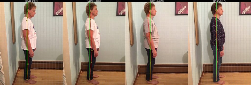Photo showing improvements in posture of a female client over 3 treatments