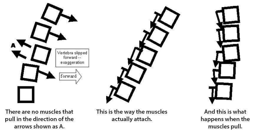 Graphic showing what happens when a vertebra is displaced in a forward direction