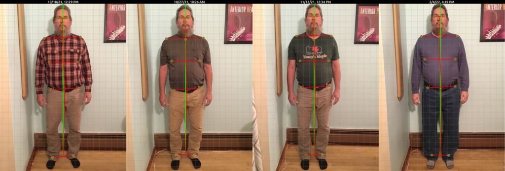 Photo showing side view of Dave Yeany's posture at different stages of his treatment course