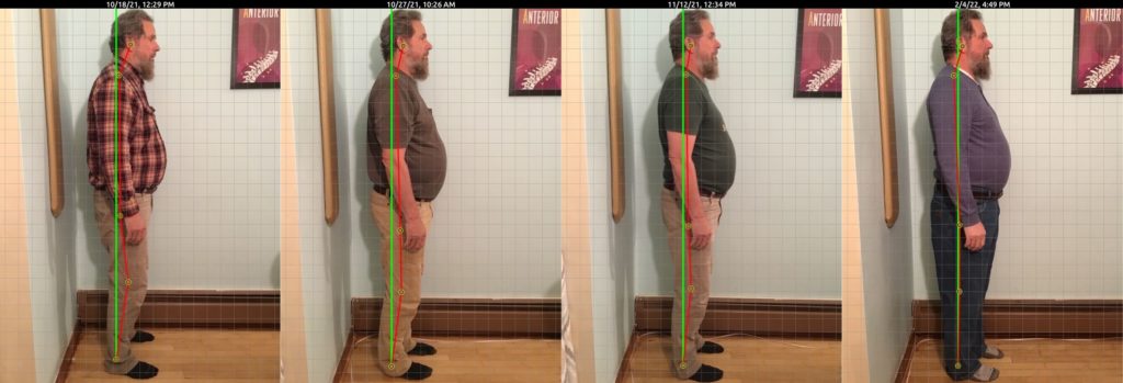 Photo showing side view of Dave Yeany's posture at different stages of his treatment course